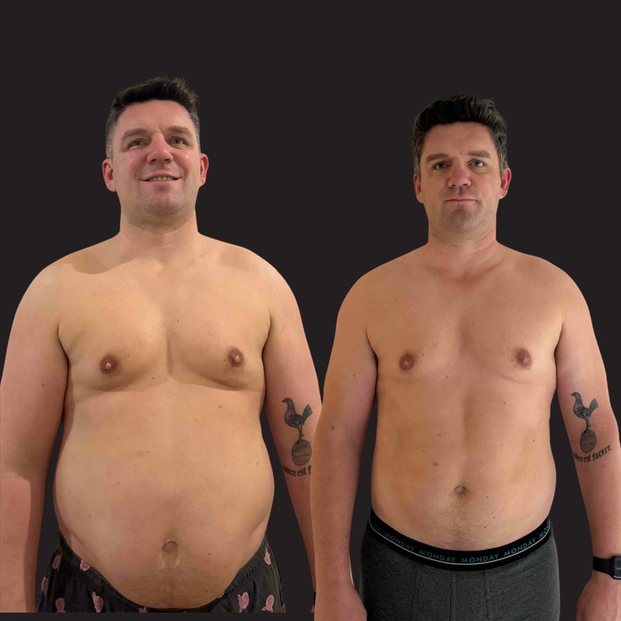 LFG member before and after: significantly smaller stomach